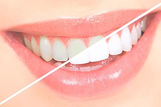 Teeth Whitening