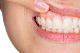 Gum Disease