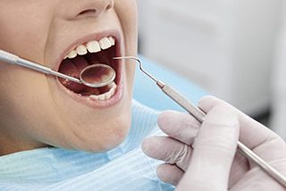 Dental Fillings