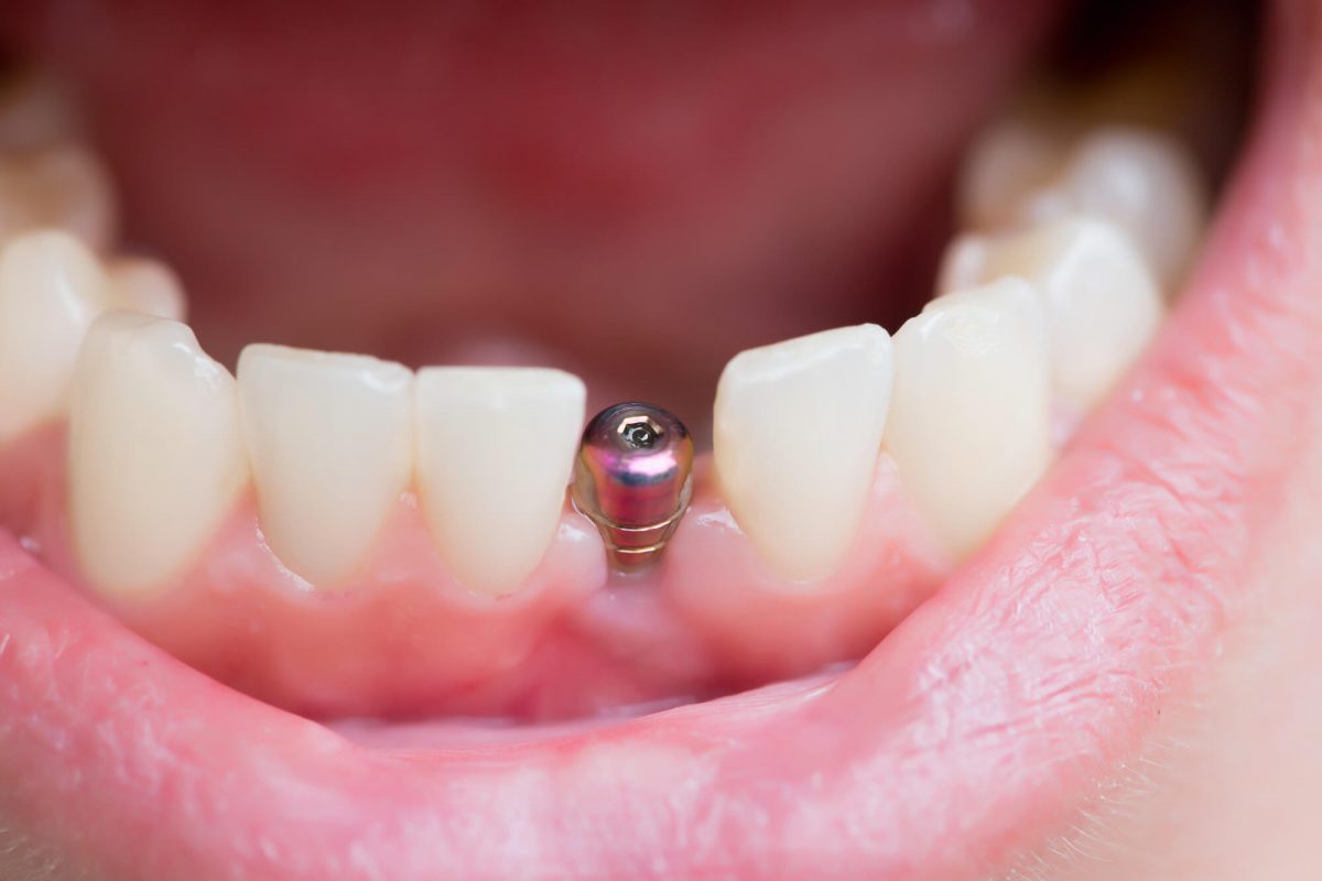 dental-implant-care-1200x800.jpeg